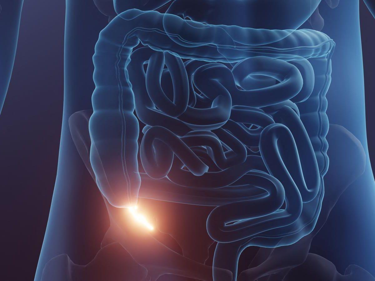 Efficacité des antibiotiques pour traiter l'appendicite Efficacité des antibiotiques pour traiter l'appendicite