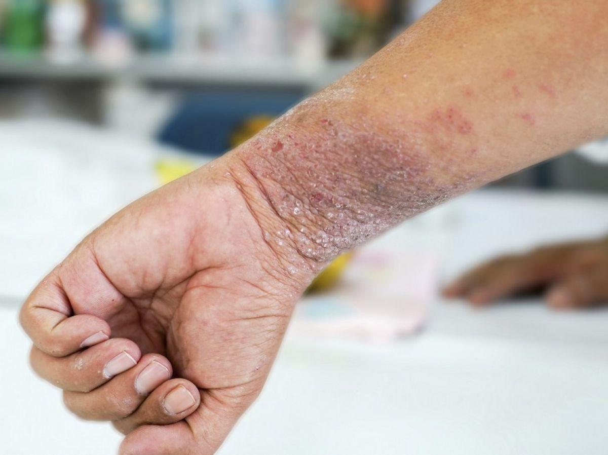 Eczéma : comment s'en débarrasser ? Eczéma : comment s'en débarrasser ?