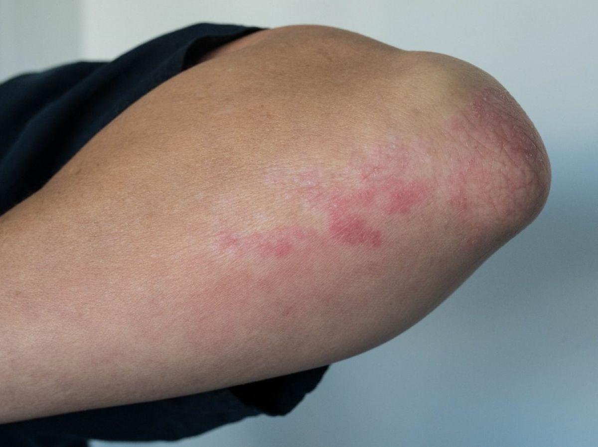 Une bactérie de la peau responsable à elle seule des démangeaisons dans le psoriasis ou les dermatites atopiques Une bactérie de la peau responsable à elle seule des démangeaisons dans le psoriasis ou les dermatites atopiques