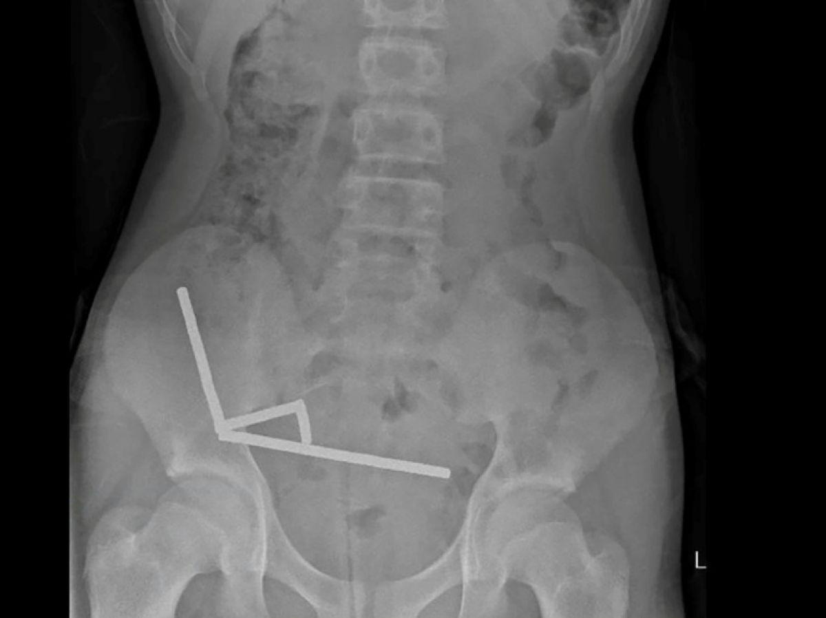 Adolescent Opéré Après Avoir Ingéré 100 Aimants Adolescent Opéré Après Avoir Ingéré 100 Aimants