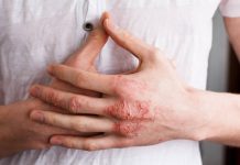 Eczéma: Fréquence de lavage n’affecte pas les symptômes Eczéma: Fréquence de lavage n'affecte pas les symptômes