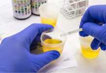 Glycosurie: Causes, Symptômes, Diagnostic et Prise en Charge Glycosurie: Causes, Symptômes, Diagnostic et Prise en Charge