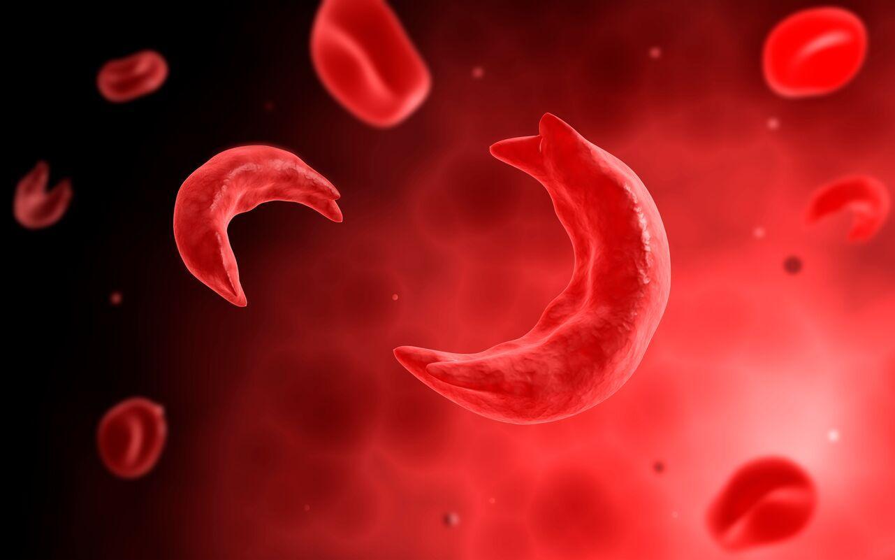 How we can manage sickle cell disease How we can manage sickle cell disease