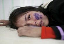 ارتفاع عدد المصابين بالليشمانيا في ليبيا إلى 5000 حالة