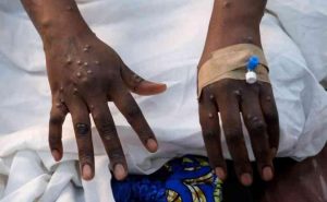 Zambia Reports First Mpox Case, Variant Unclear - Zambia