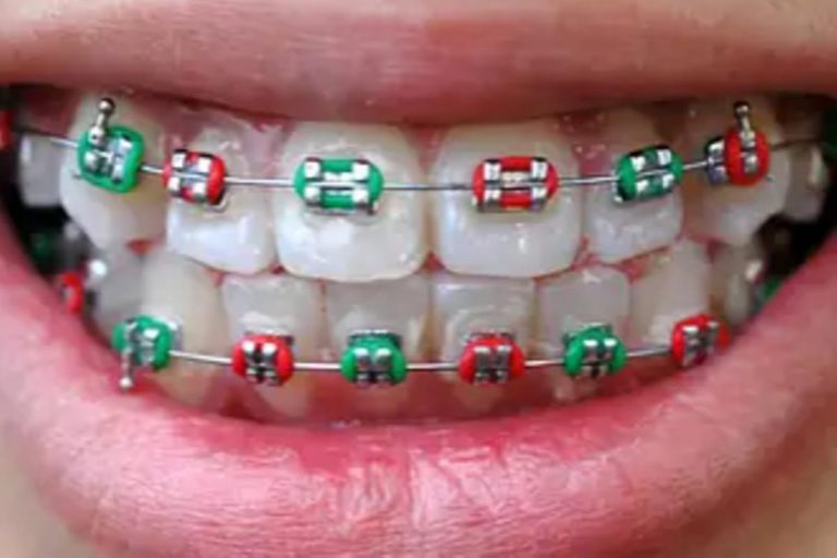 Does my child need braces?