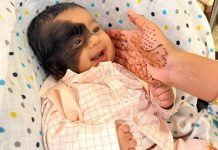 ‘I hope they won’t make him feel out of place’: Boy’s birthmark draws nasty comments 'I hope they won't make him feel out of place': Boy's birthmark draws nasty comments