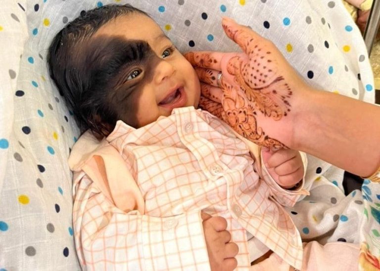 'I hope they won't make him feel out of place': Boy's birthmark draws nasty comments
